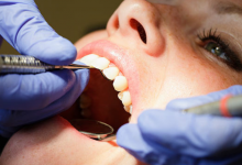 Deep Teeth Cleaning