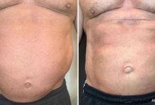 Stomach tightening