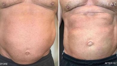 Stomach tightening