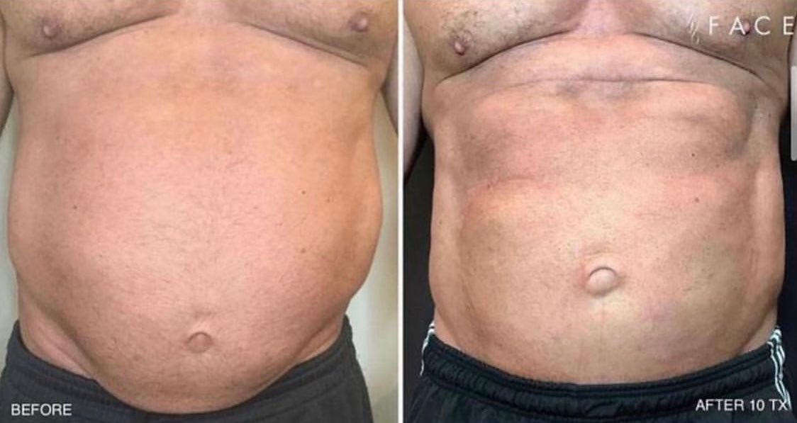 Stomach tightening