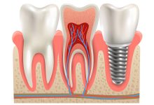 dental implants Surrey