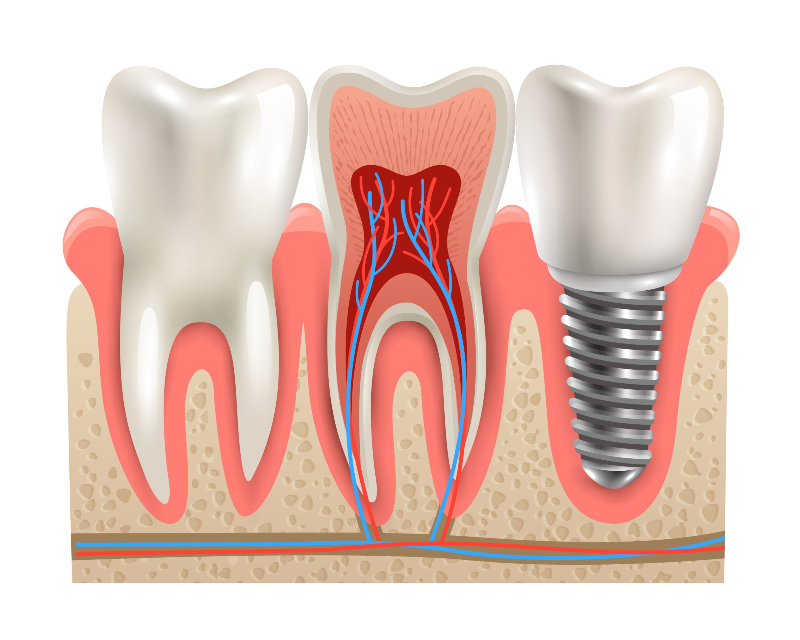 dental implants Surrey